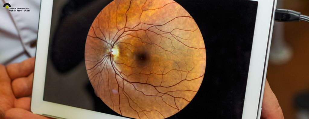fotografia retiniană este un instrument de diagnostic foarte folositor, non-invaziv, ce produce imagini digitale colorate de înaltă rezoluție ale structurilor fundului de ochi