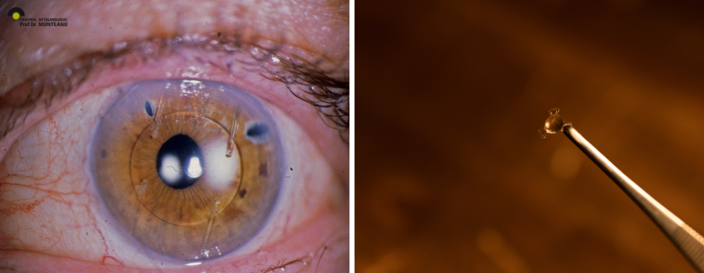 Macula Lens este o lentila special conceputa si implantata in ochi pentru tratarea problemelor de vedere legate de macula