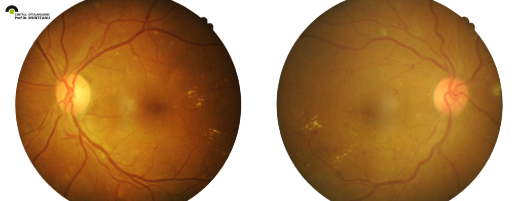 Dezlipirea de retina este atunci cand retina se detaseaza de celelalte straturi ale ochiului