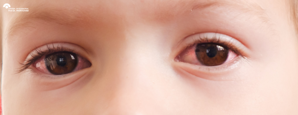 cauze comune ochi rosii copii, oftalmologie